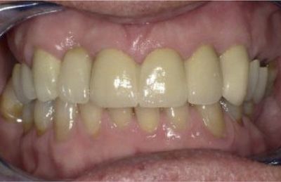 Ästhetisches Ergebnis nach Versorgung der Zähne mit Keramikkronen Ästhetisches Ergebnis nach Versorgung der Zähne mit Keramikkronen