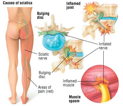 SCIATICA