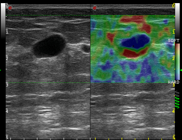 elastosonografia