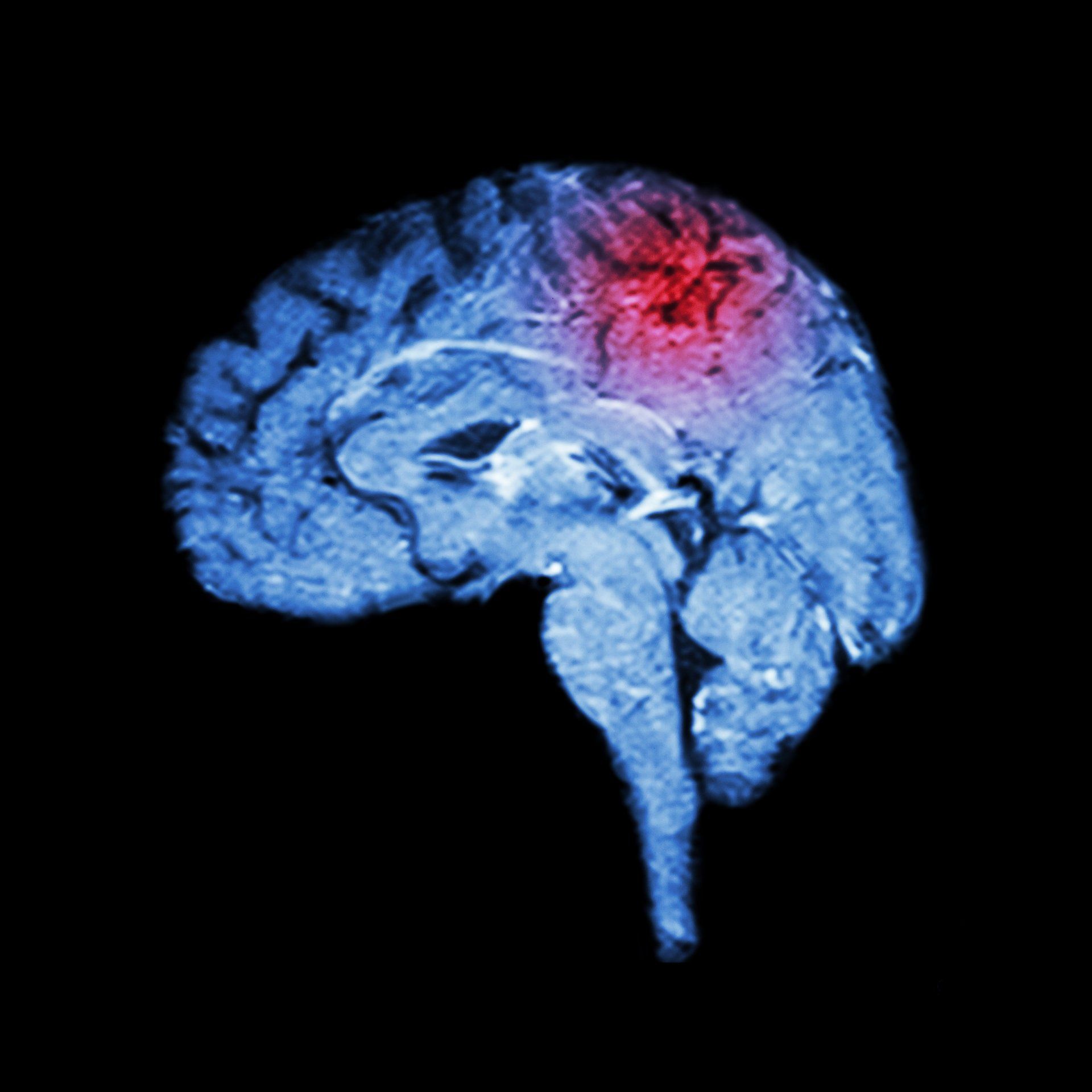 Brain Injury