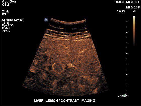 Contrast Enhanced Ultrasound