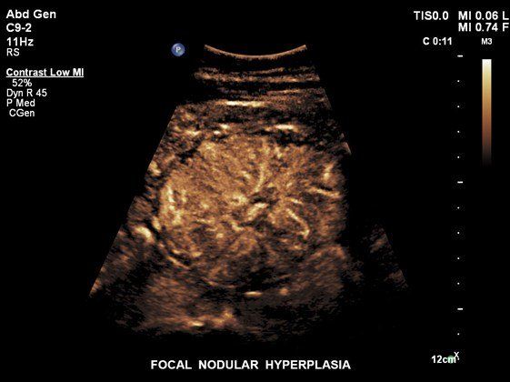 Contrast Enhanced Ultrasound