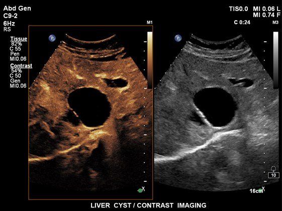 Contrast Enhanced Ultrasound
