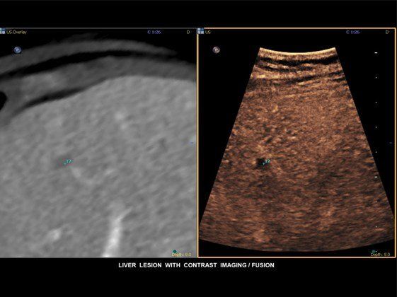 Contrast Enhanced Ultrasound