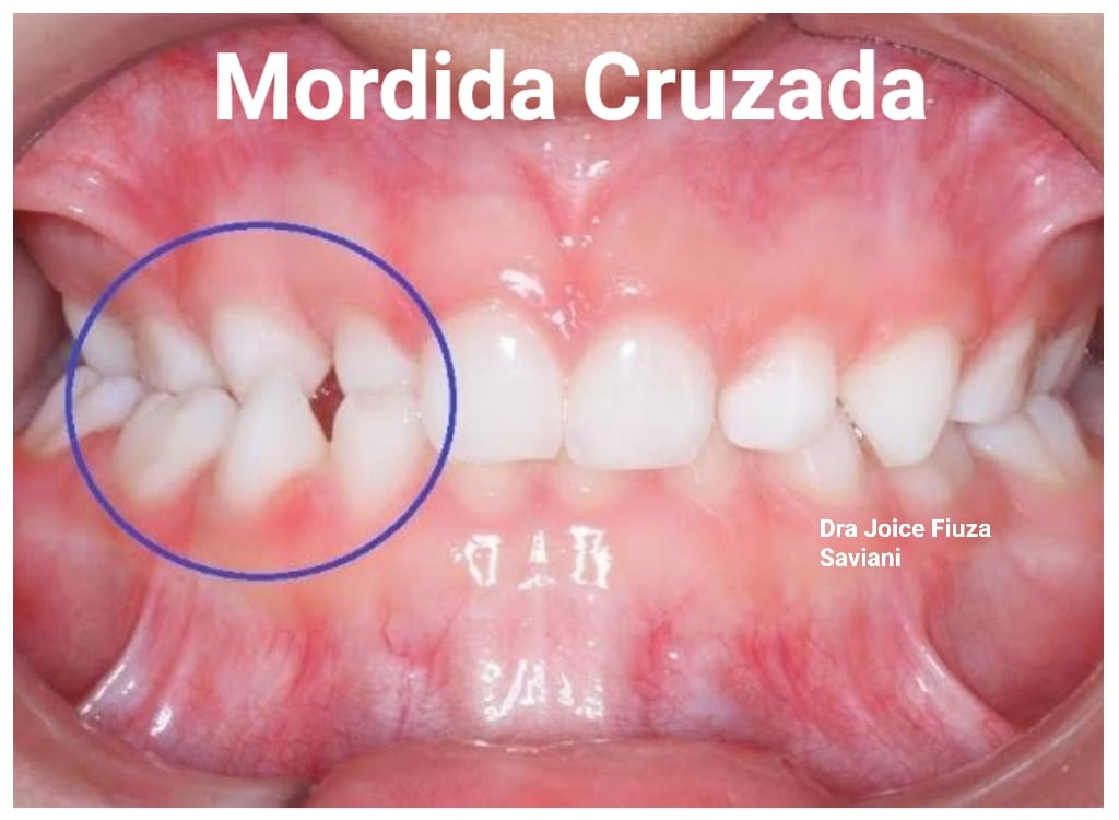 Mordida Cruzada Invisalign para crianças