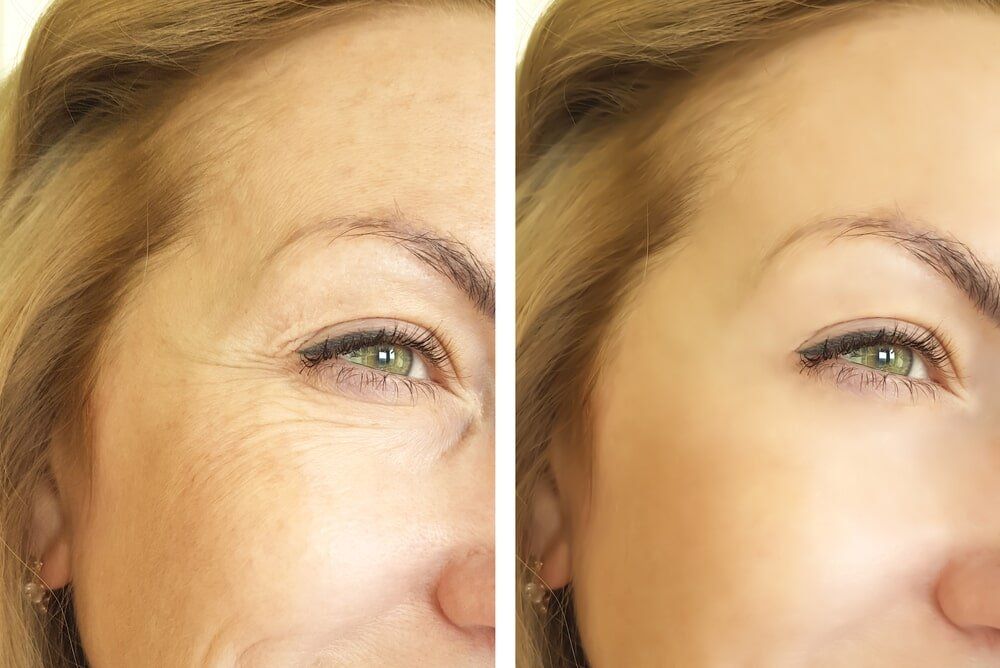 Botox in Glen Mills PA Botox in Glen Mills PA