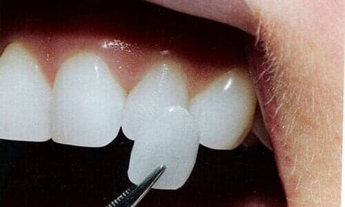 Veneers - Cosmetic Dentistry in Garnet Valley, PA Veneers - Cosmetic Dentistry in Garnet Valley, PA