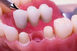 Dental bridge being placed on pink gums, replacing a missing tooth.