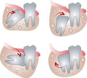 Four diagrams showing impacted wisdom teeth and their movement within the jaw.
