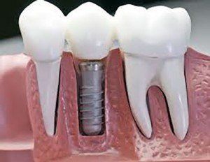 Dental model showing a tooth implant fixed between two natural teeth.
