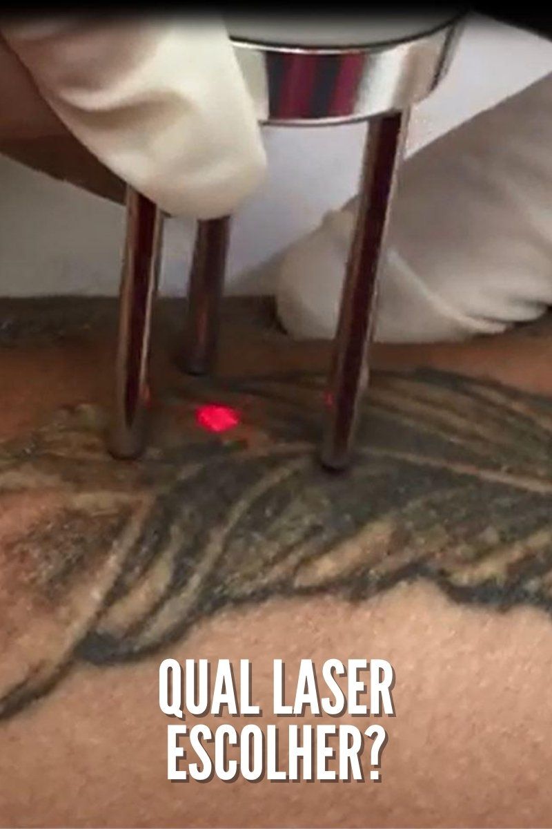 Qual laser escolher para a Remoção de Tatuagens? Qual laser escolher para a Remoção de Tatuagens?