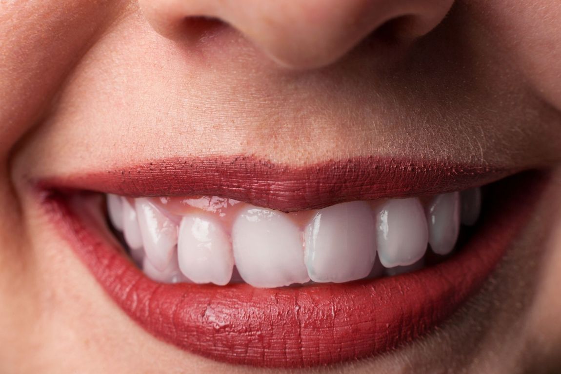 denti prima e dopo seduta di sbiancamento