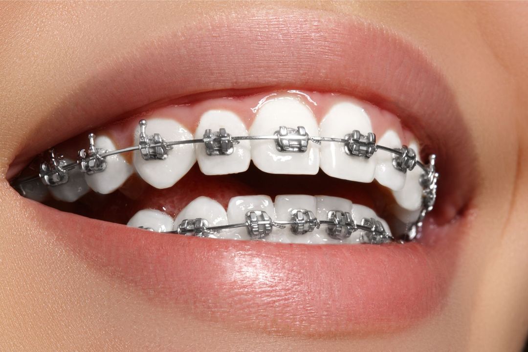apparecchio denti fisso