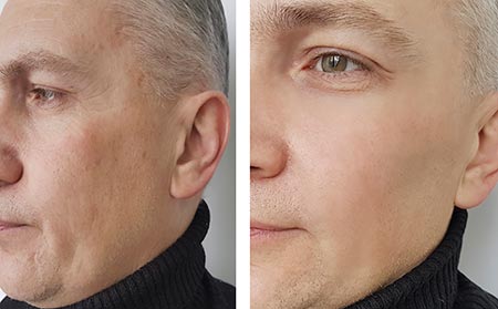 Botox — Man Before And After Botox in Merrillville, IN Botox — Man Before And After Botox in Merrillville, IN