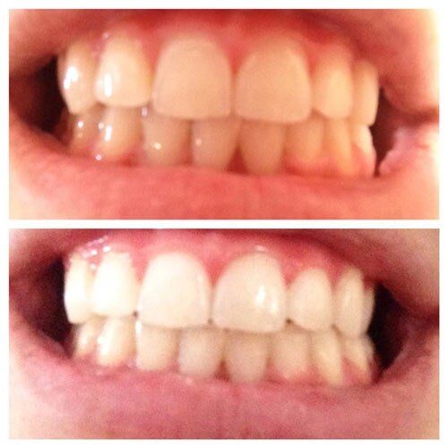 Oral Health — Before And After Teeth Whitening in Merrillville, IN Oral Health — Before And After Teeth Whitening in Merrillville, IN