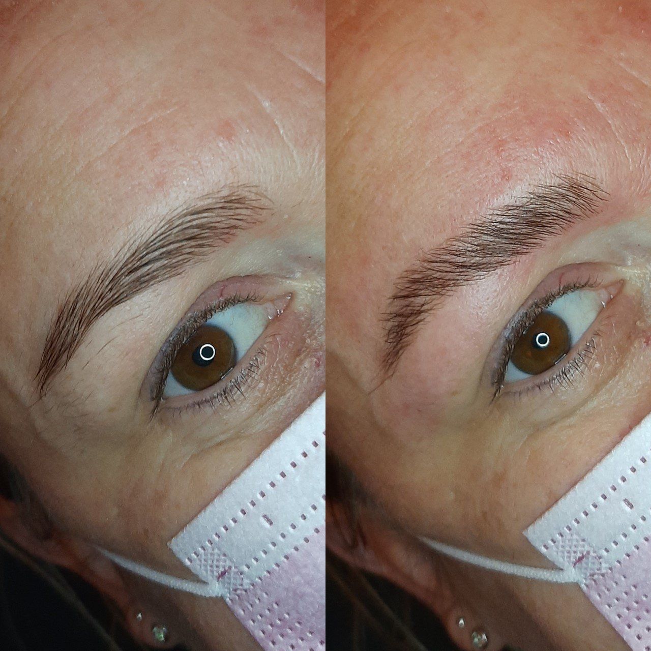 brow lifting