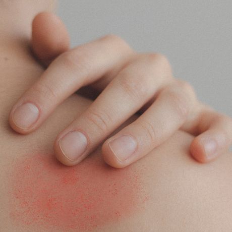 Allergy-Testing-in-Gladstone-Missouri