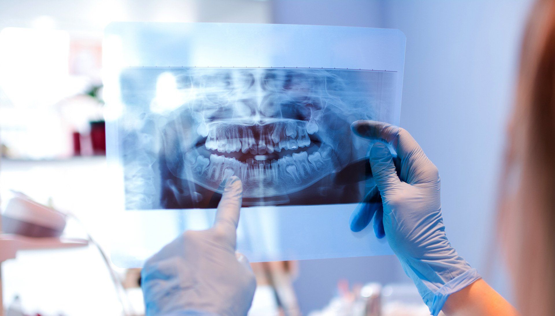 Dentist X-ray Result — Pensacola, FL — Dr. Phillip Drlicka, D.D.S. Dentist X-ray Result — Pensacola, FL — Dr. Phillip Drlicka, D.D.S.
