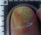 Nail Diseases — Pensacola, FL — Pensacola Podiatry