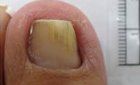 Nail Disorders — Pensacola, FL — Pensacola Podiatry