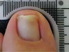 After Mycotic Nails Treatment — Pensacola, FL — Pensacola Podiatry