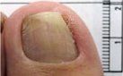 After Nail Disorders Treatment — Pensacola, FL — Pensacola Podiatry