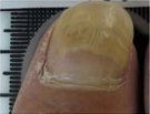 Nail Psoriasis — Pensacola, FL — Pensacola Podiatry