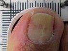 Vertical Ridges — Pensacola, FL — Pensacola Podiatry