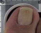 After Vertical Ridges Treatment — Pensacola, FL — Pensacola Podiatry