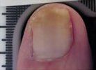 After Nail Psoriasis Treatment — Pensacola, FL — Pensacola Podiatry
