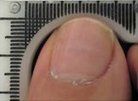 After Mycosis Nails Treatment — Pensacola, FL — Pensacola Podiatry
