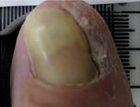 Onycholysis Nail — Pensacola, FL — Pensacola Podiatry