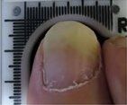 After Laser Treatment — Pensacola, FL — Pensacola Podiatry