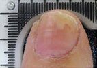 Mycosis Nails — Pensacola, FL — Pensacola Podiatry