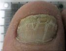 After Dystrophic Nail Treatment — Pensacola, FL — Pensacola Podiatry