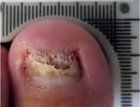 Onychatrophia Nail — Pensacola, FL — Pensacola Podiatry
