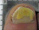 Nail Atrophy — Pensacola, FL — Pensacola Podiatry