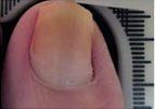 After Onycholysis Nail Treatment — Pensacola, FL — Pensacola Podiatry