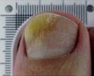 After Nail Apparatus Treatment — Pensacola, FL — Pensacola Podiatry