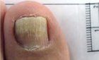 Lacuna Nail Before — Pensacola, FL — Pensacola Podiatry