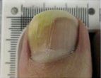 Nail Apparatus — Pensacola, FL — Pensacola Podiatry
