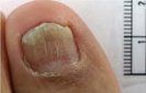 After Lacuna Treatment — Pensacola, FL — Pensacola Podiatry