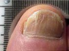After Nail Atrophy Treatment — Pensacola, FL — Pensacola Podiatry