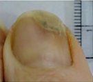 After Ringworm Treatment — Pensacola, FL — Pensacola Podiatry