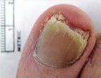 After Nail Fungal Treatment — Pensacola, FL — Pensacola Podiatry