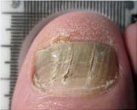 Dystrophic Nail — Pensacola, FL — Pensacola Podiatry