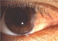 Eye