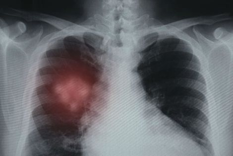 Lastra apparato respiratorio
