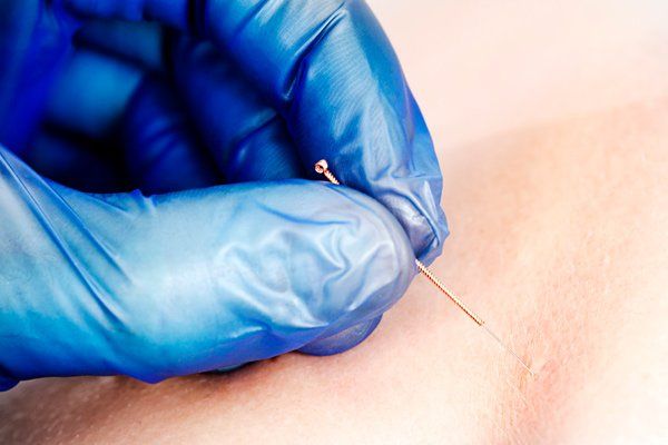 dry needling treatment