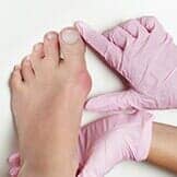 Bunion in Woman Foot — Bunions in Chicago, IL